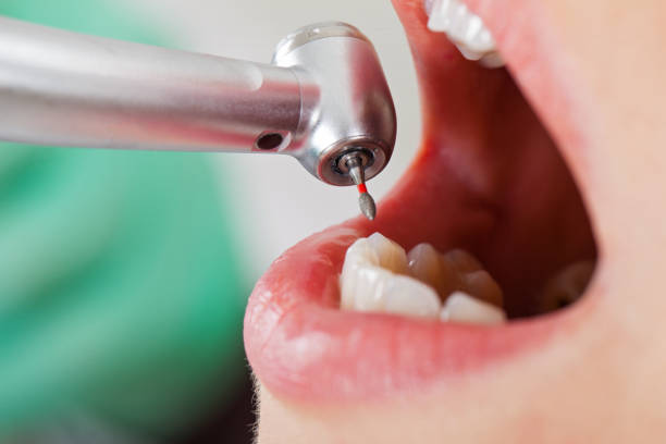 Best Broken or Chipped Tooth Repair in Exmore, VA